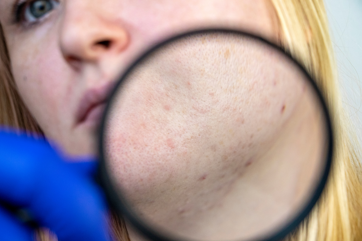 Woman with Acne  
